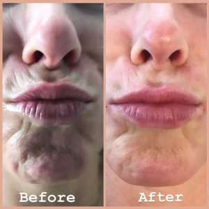 Lip Lines commonly called Smokers Lines