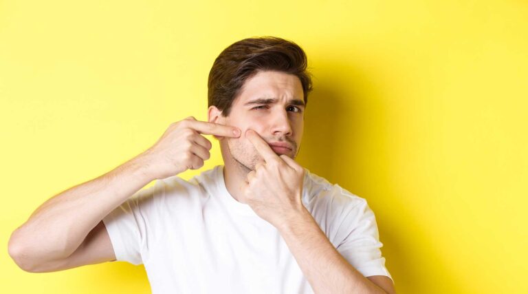 young-man-acne