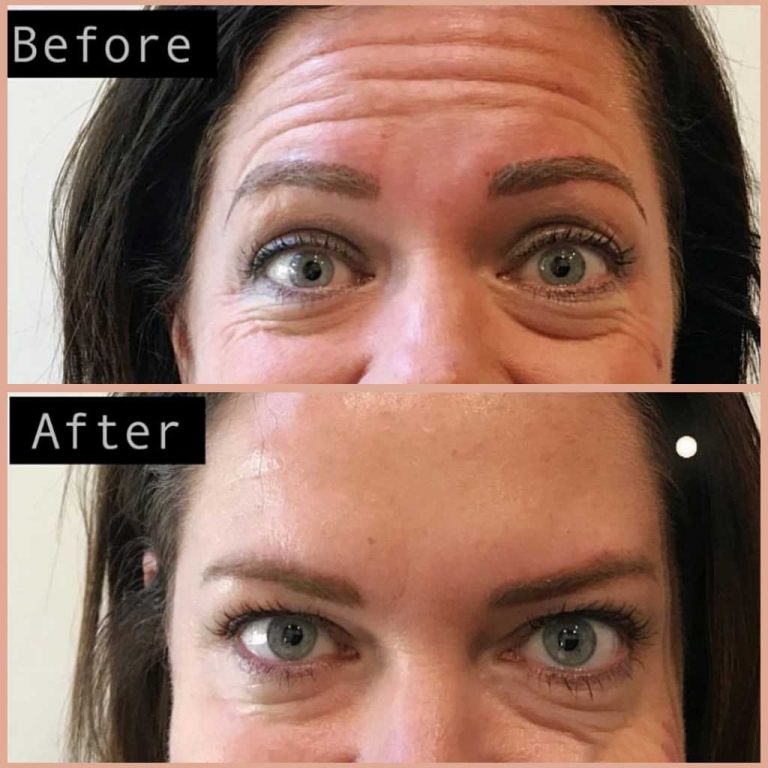Forehead Injections Result