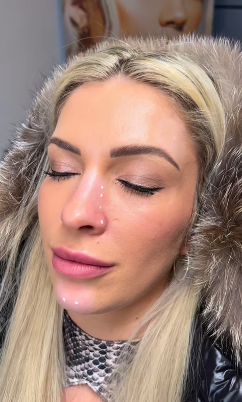 Nose slimming botox