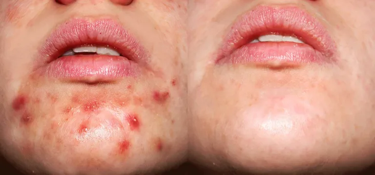 acne-treatment-before-after