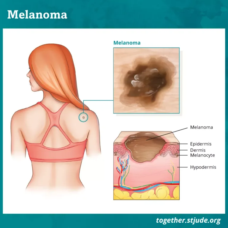 K01003-together-melanoma-illustration-2020